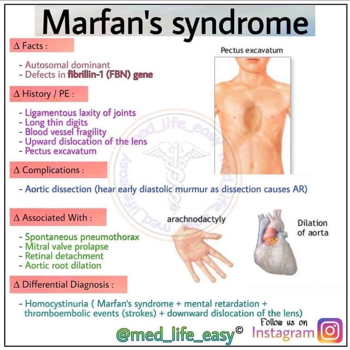 Marfan syndrome