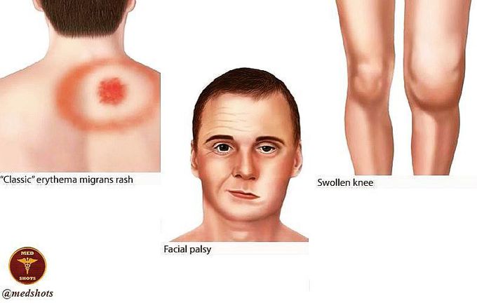 Lyme disease