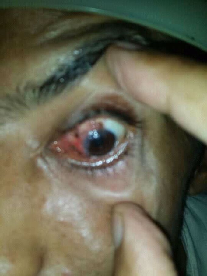 25 OLD HAVING LESION  .DD AND treatment?