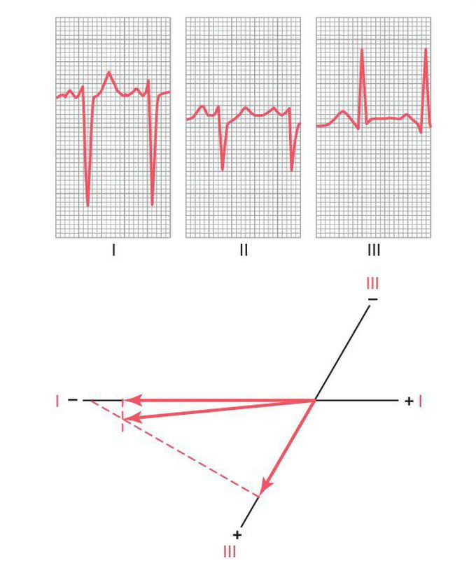 Right ventricle hypertrophy