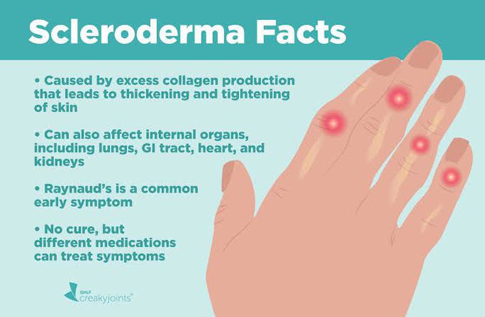 Complications of scleroderma