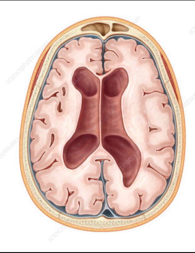 What is Adam’s triad/Hakim’s triad?                               In normal pressure hydrocephalus , triad of Urinary incontinence, gait instability and dementia/mental decline.