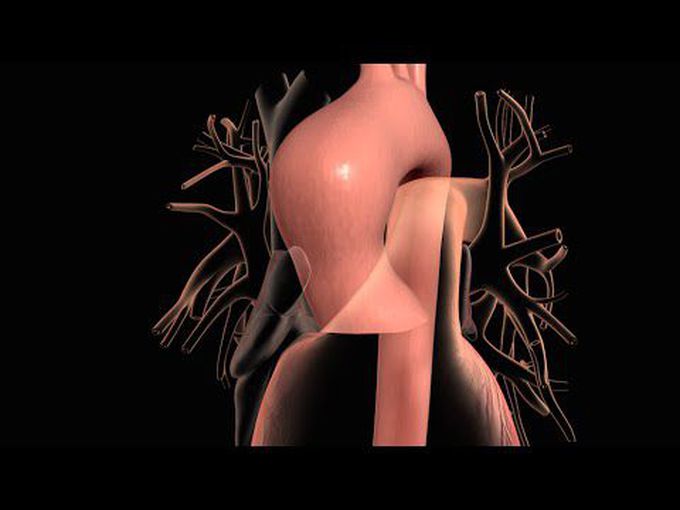 Aortic Aneurysm and Aortic Dissection-
Animation