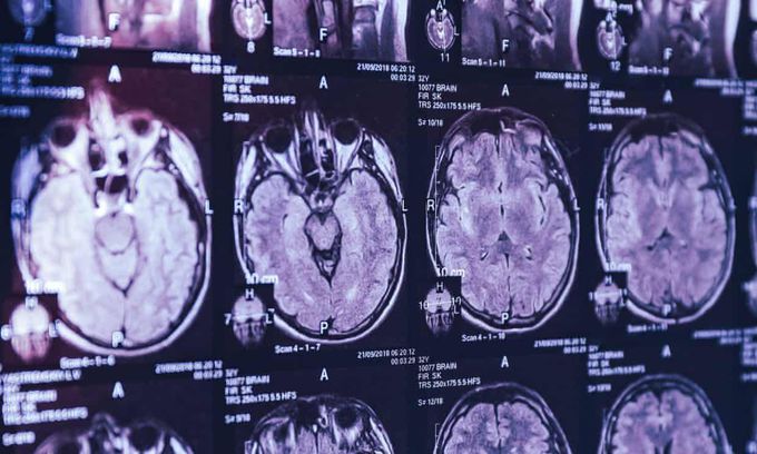 Canada Reports Cluster of Mysterious Brain Disease