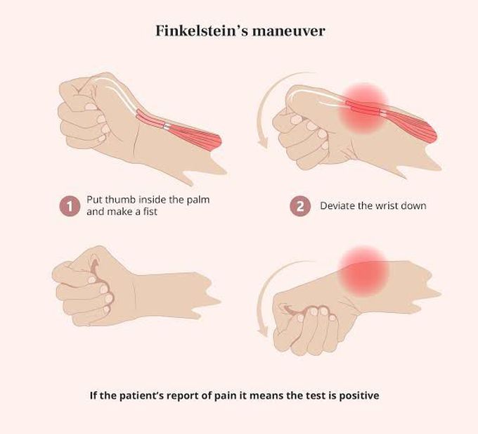 Finkelstein's Maneuver