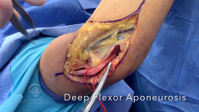 Anatomy and Surgery of Ulnar Nerve Decompression/ Transposition at Elbow (Cubital Tunnel)