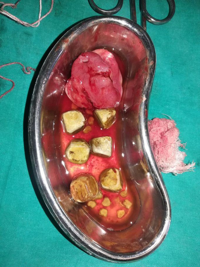 Cholelithiasis