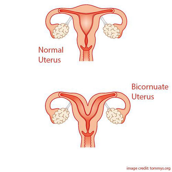 What are the symptoms of a bicornuate uterus?