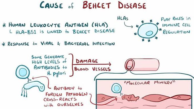 Causes of behcet syndrome