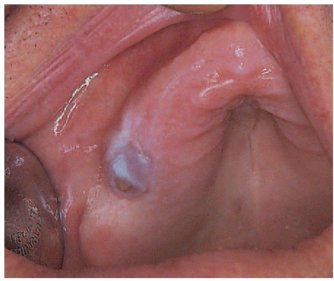 Giant cell granuloma.