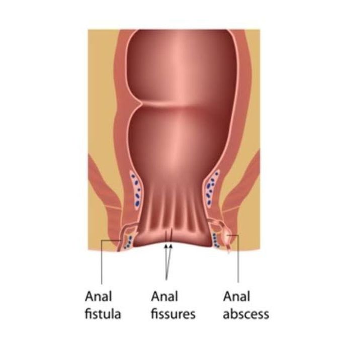 Pathology of Anal Canal - MEDizzy