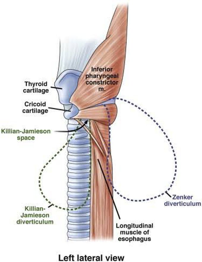 Zenker's diverticulum