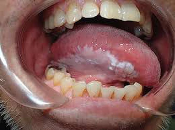 Causes of leukoplakia