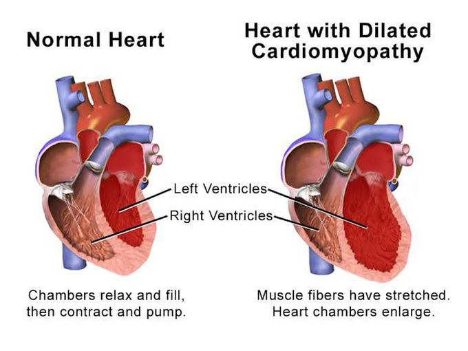 Symptom of dilated cardiomyopathy