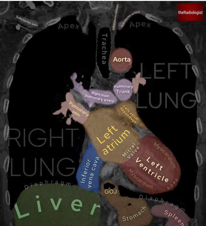 Coronal Chest CT Anatomy