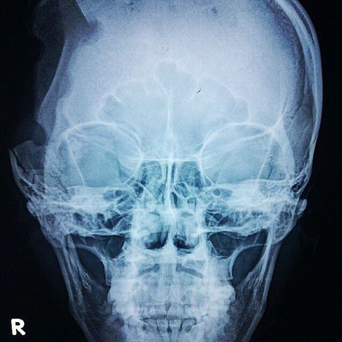 Craniotomy by X-Ray