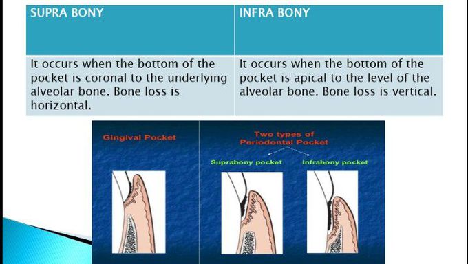 Infrabony and suprabony periodontal pockets.