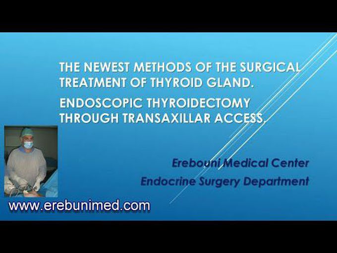 Endoscopic 
Thyroidectomy