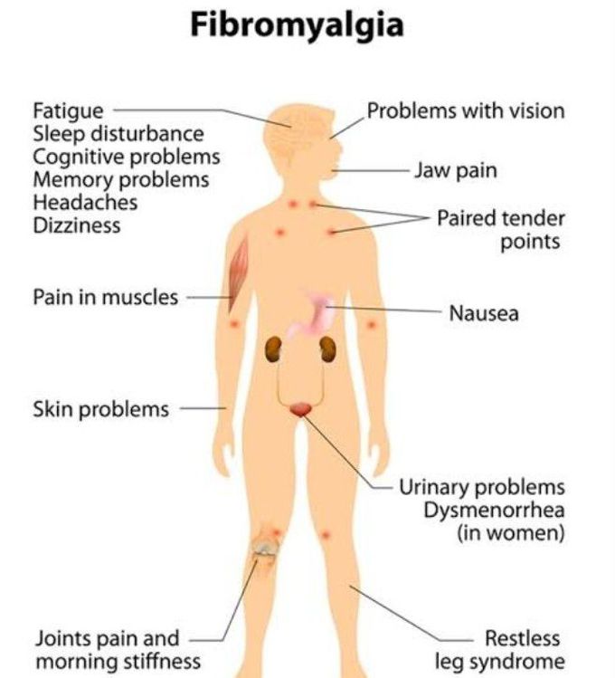 Fibromyalgia