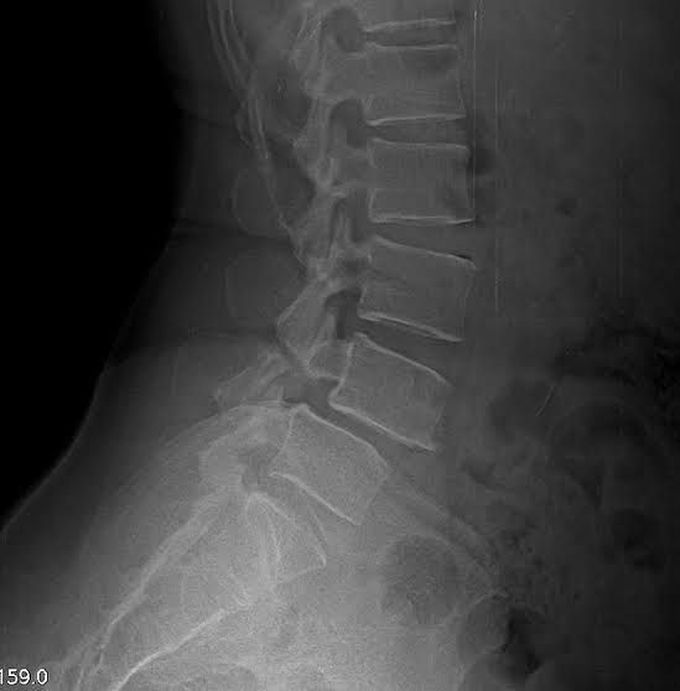 This Lumber plain x-ray shows forward slipping of L4 over L5 Leading to comprresion of the root L4 leading to loss of extension of Knee (Quadriceps femoris) and lost knee relfex with loss of sensation over medial calf,  medial malleolus and medial foot