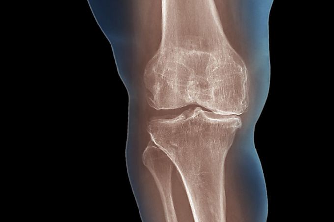 Causes of degenerative joint disease