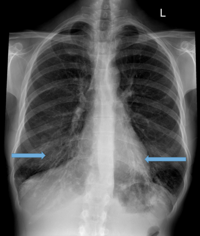 Tram Tracking on Chest X-ray in a patient with Bronchiectasis