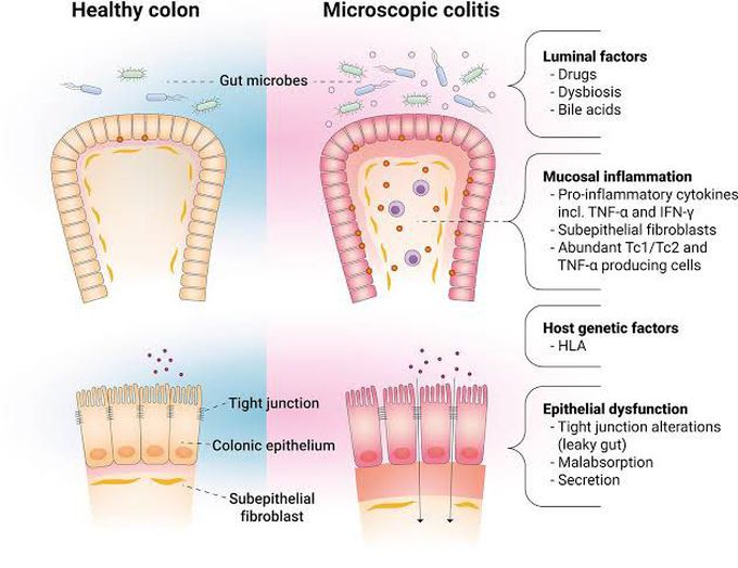 Microscopic Colitis