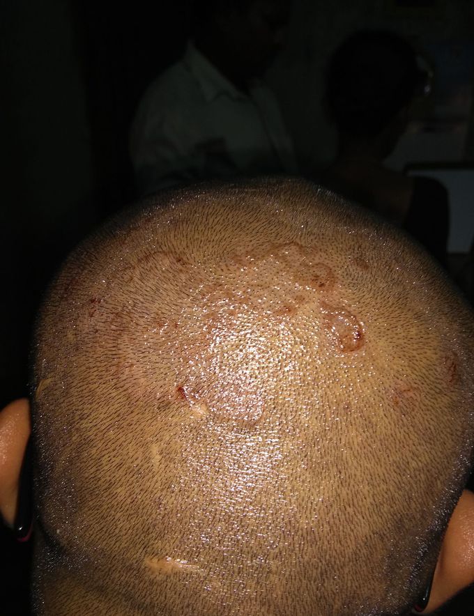 Red patches on scalp