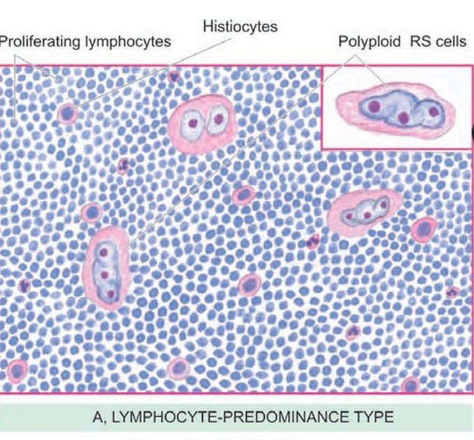 Lymphocyte-predominance (hodgekin's lymphoma)