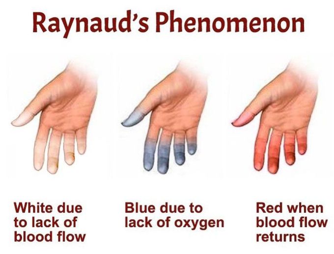 Raynaud's Phenomenon