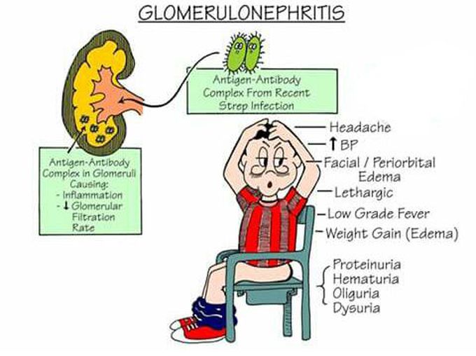 In brief about Glomerulonephritis