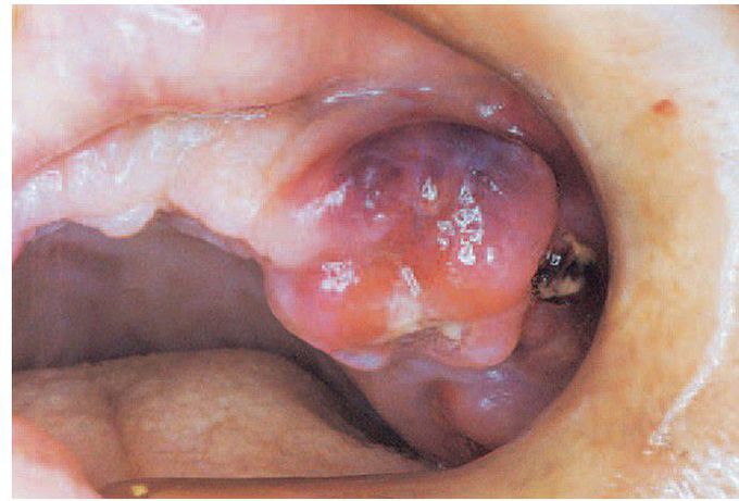 Myeloid leukaemia