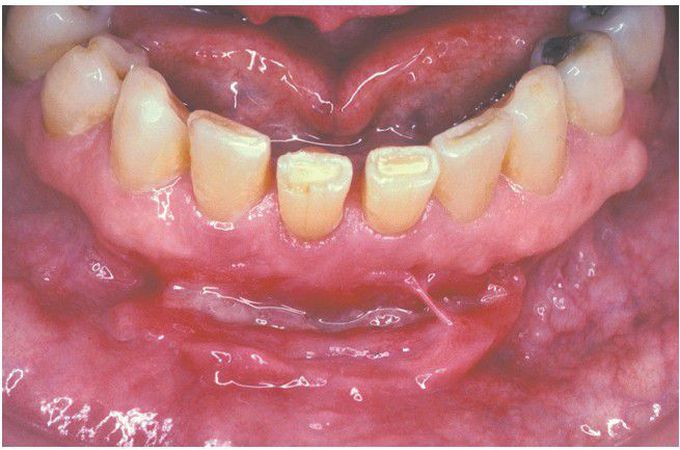 Crohn Disease.