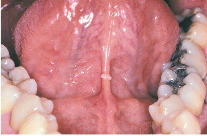 Fibrous Hyperplasia from Repeated Cunnilingus.
