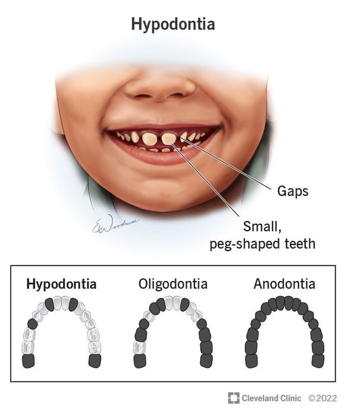 Hypodontia