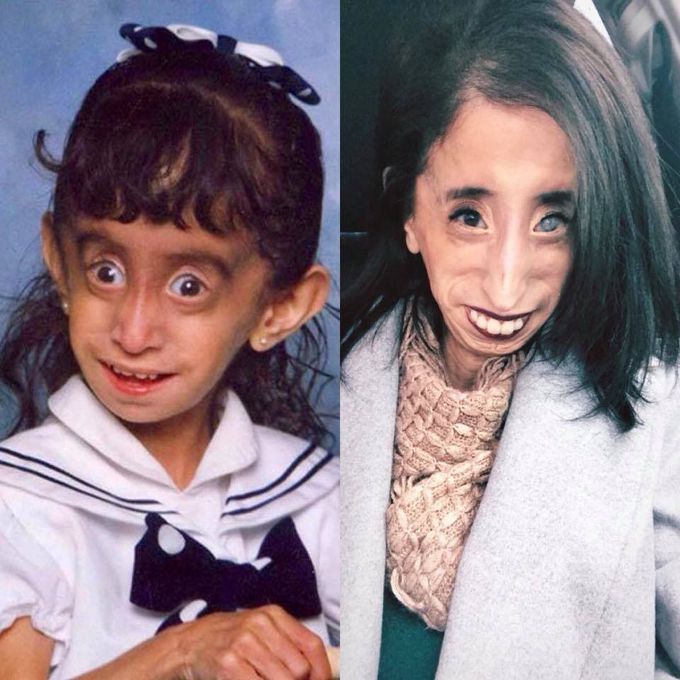 Lizzie Velasquez(Marfanoid–progeroid–lipodystrophy syndrome)