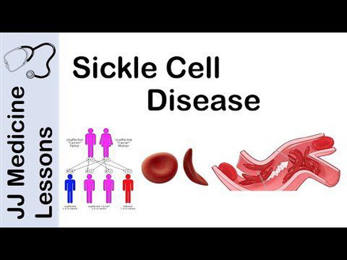 Pathology of Sickle Cell Anaemia