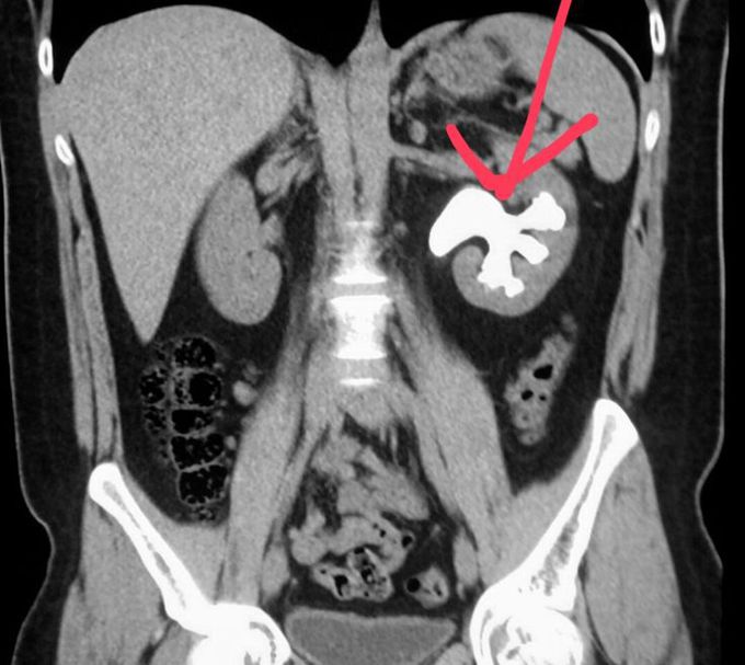Large kidney stone