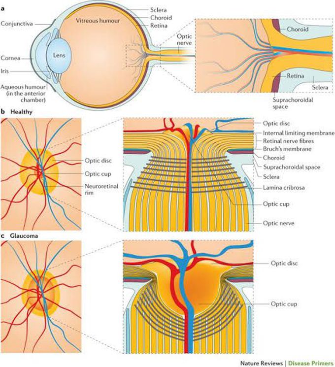 Glaucoma - MEDizzy