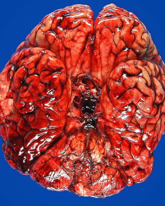 Ruptured aneurysm at the base of the brain that resulted in subarachnoid hemorrhage!