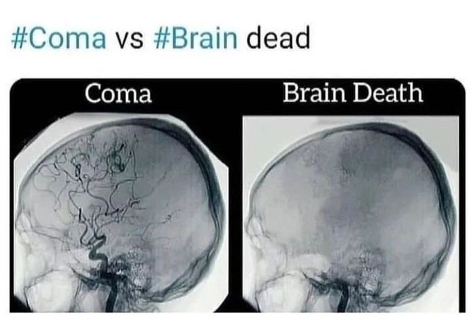 Coma Brain Vs Brain Dead