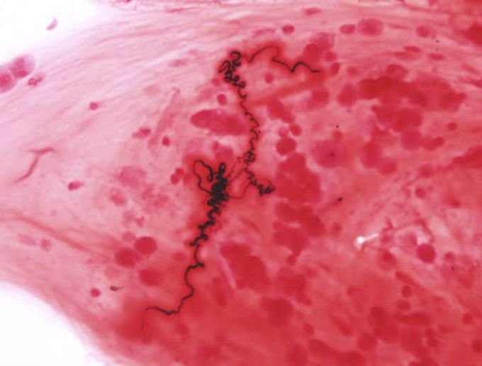  IDENTIFY and NAME this microscopic finding in the sputum of asthmatics.