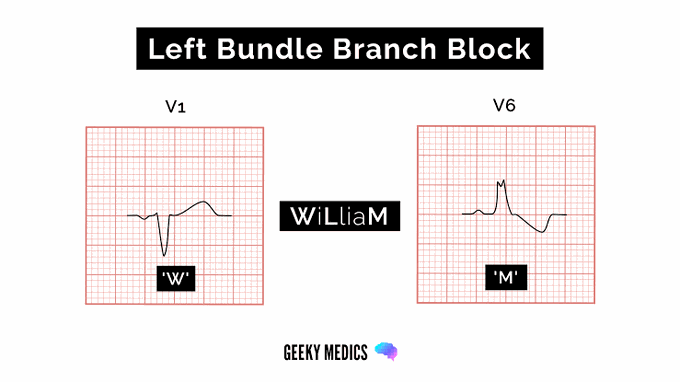 Left Bundle Branch Block