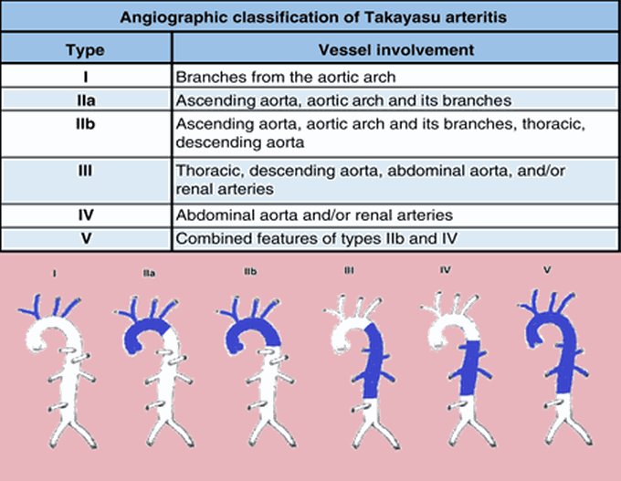 Classification of Takayasu Arteritis