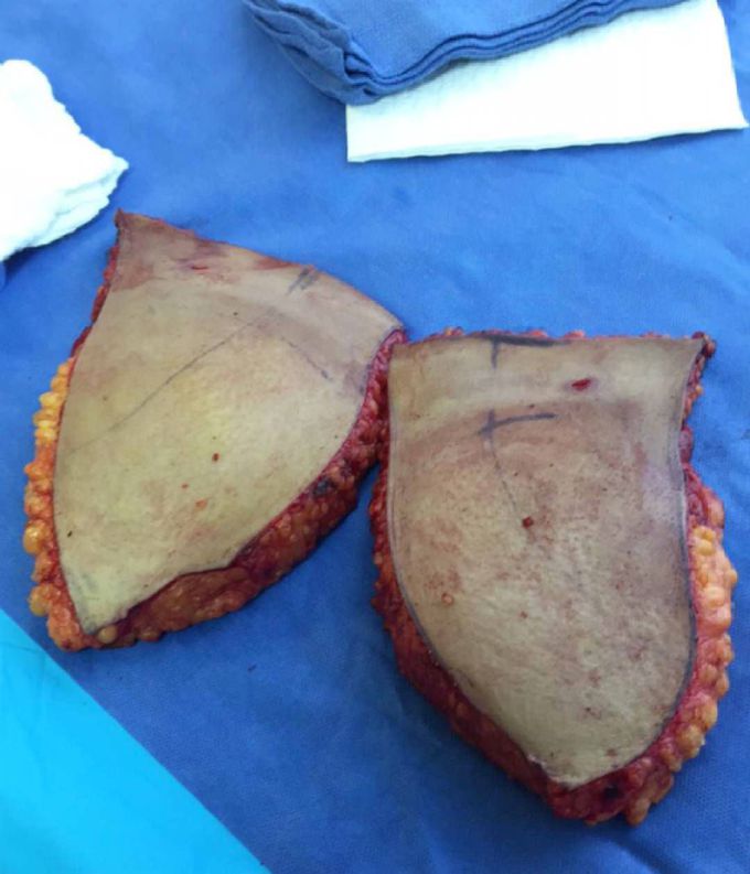 Abdominoplasty