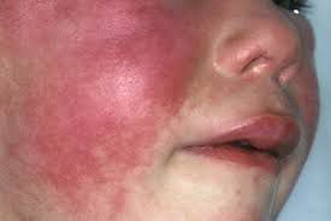 Symptoms of scarlet fever