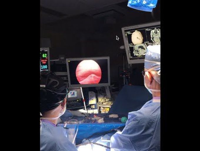 Brain Surgery : Treatment of Chiari Malformation and Hydrocephalus with minimally invasive approach