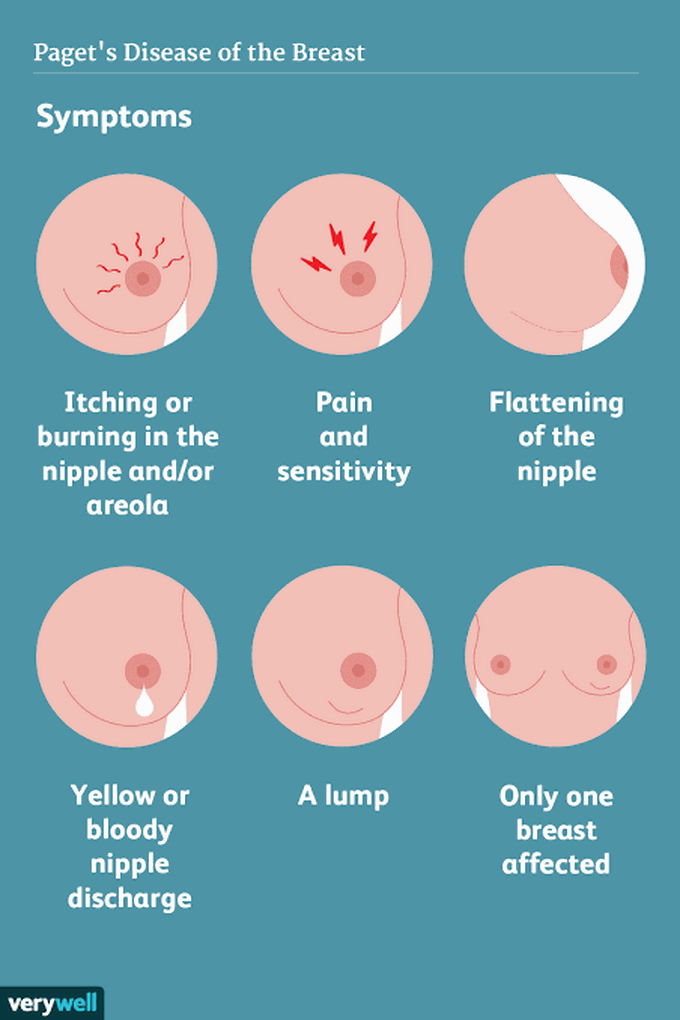 Symptoms of Paget's disease of the nipple