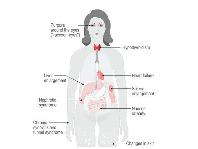 Amyloidosis treatment