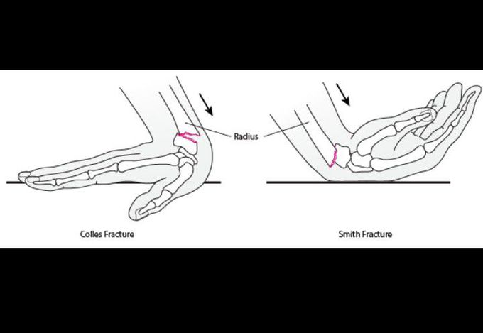 Colles Fracture and Smith Fracture